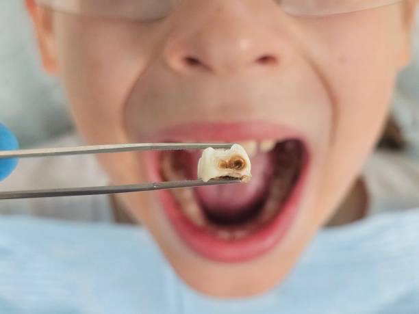 Best Emergency Tooth Extraction in Buffalo, MO